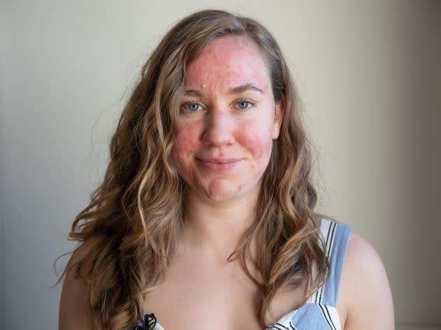 This is just one example of the many ways rosacea can display. (Photo: Barcroft Media via Getty Images)