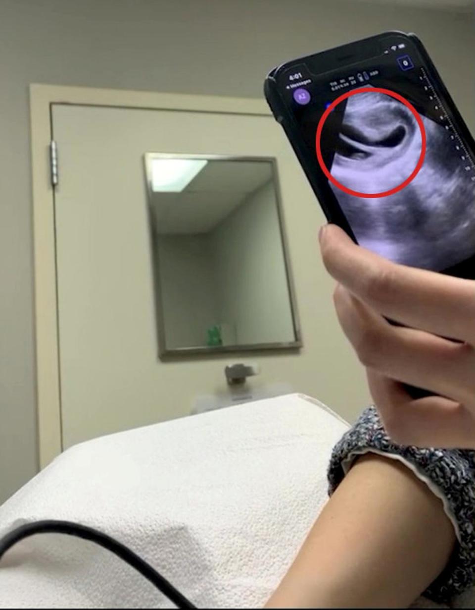 Karen having the scan where she found out she had a heart-shaped uterus (red circle) (Karen Troy / SWNS)