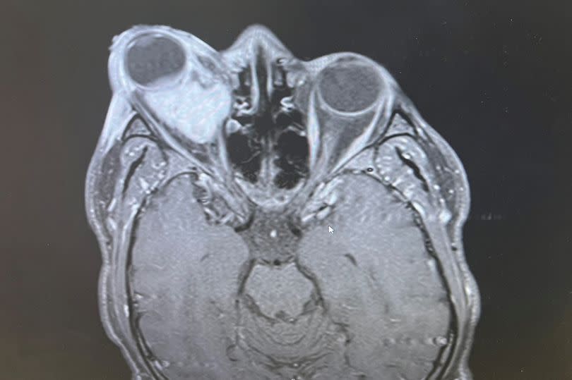 Farid's picture of the scan which shows the tumour -Credit:Collect/PA Real Life