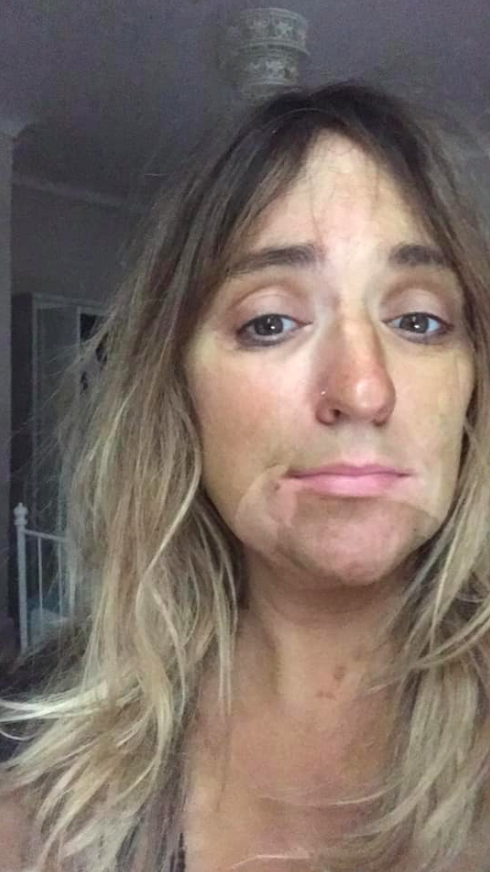 Louise Harper was left with fang-like streaks after waking up to discover that nocturnal drooling had caused a self-tanner fail. (Photo: Courtesy of Facebook/Louise Harper)