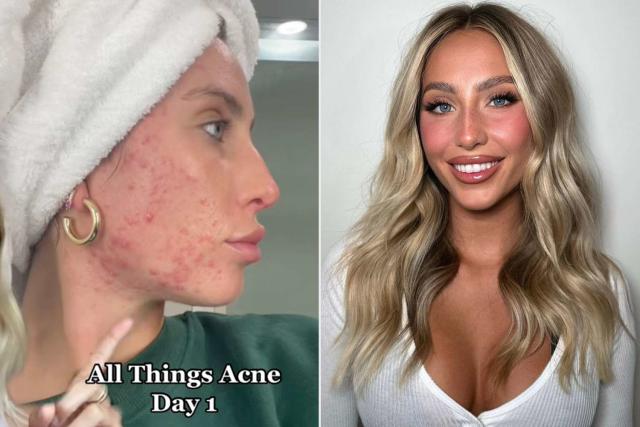 Teen Shares Viral Acne Message on Instagram