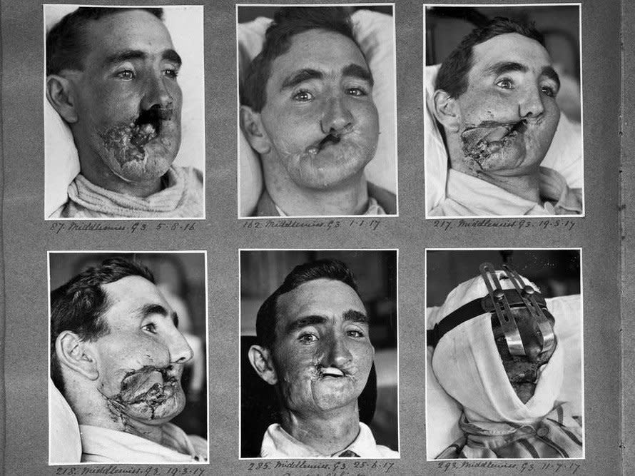 Reconstructive surgery carried out between 1916 and 1918: Wellcome