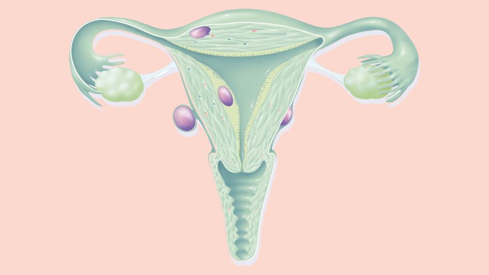 Fibroids