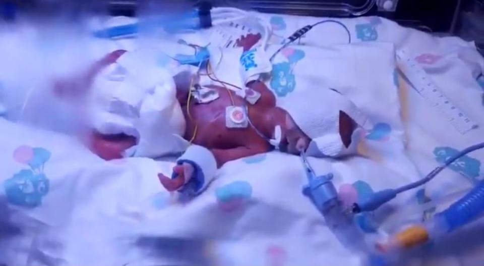 Caden Coburn in his incubator shortly after he was born in September 2019 (Josey Loughran/PA)