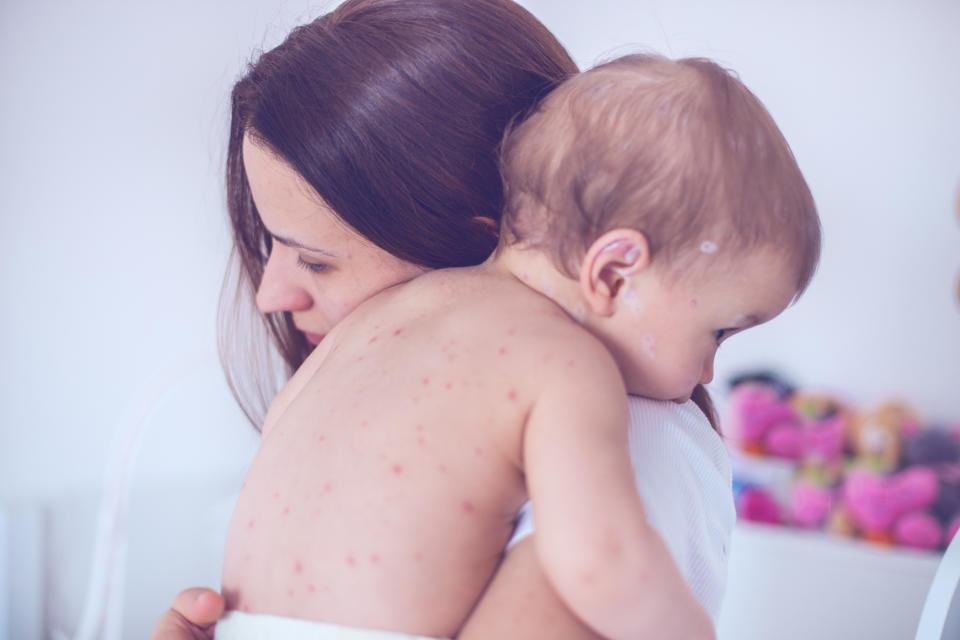 It’s difficult to know how chickenpox will impact children [Photo: Getty]