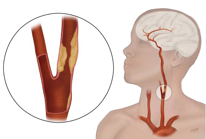 Illustration of human head and neck with enlarged pull-out view of carotid artery disease.