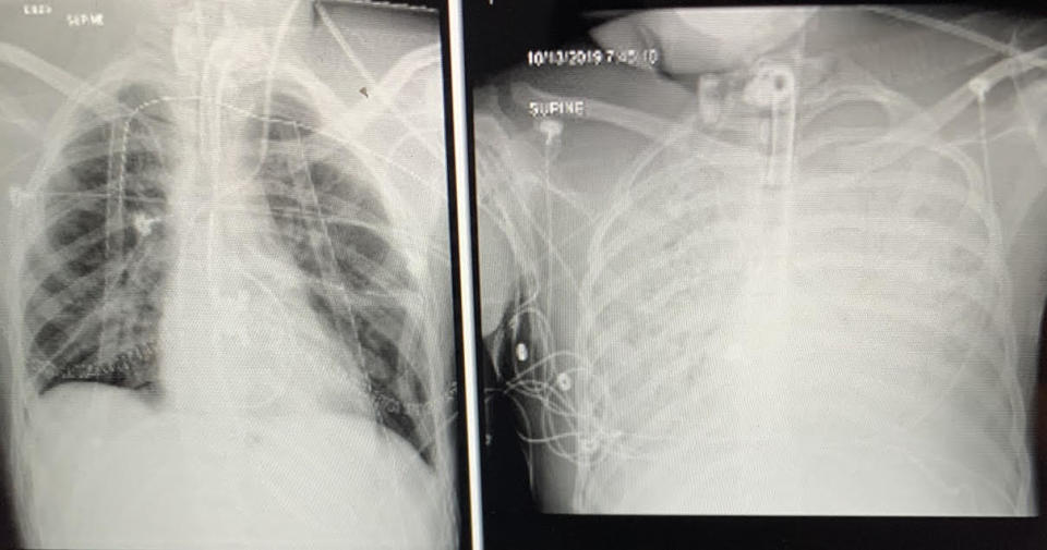 Ament's lung x-rays. | Courtesy of the Ament family