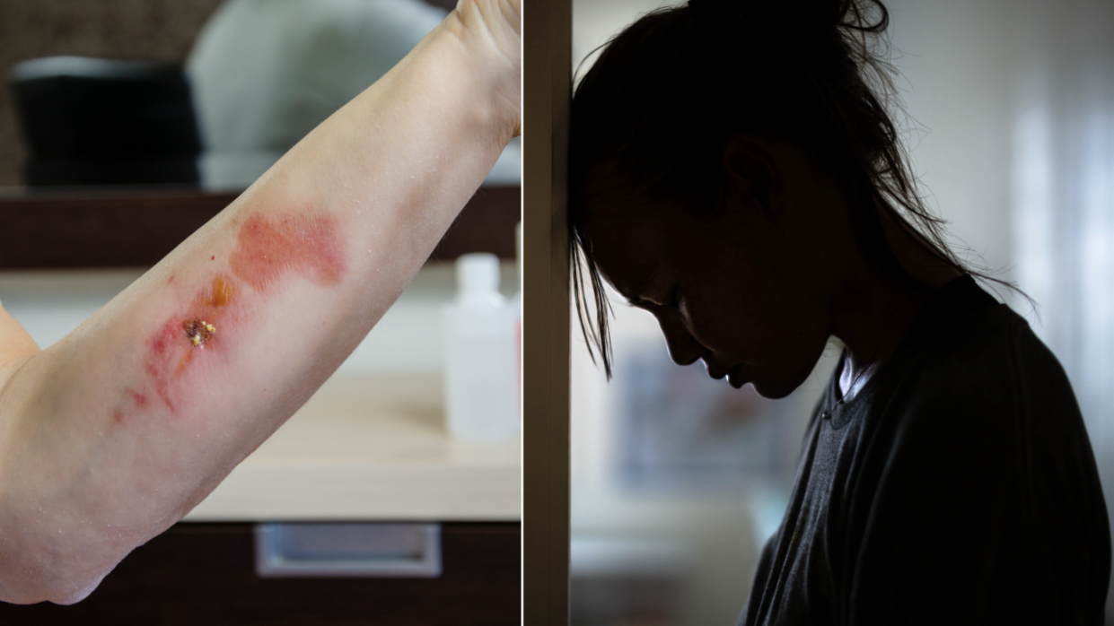 Thermal burnt skin on hand (left) and distraught woman leaning head against wall (Photos: Getty Images) 