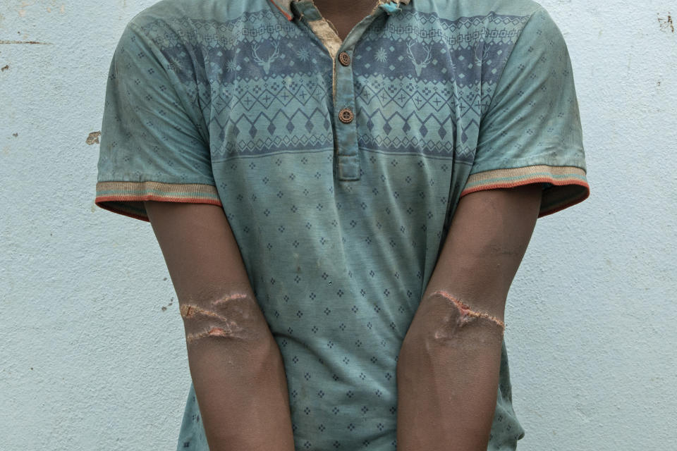 In this July 25, 2019 photo, Ehiopian migrant Ibrahim Bakalah Hassan, 24, shows scars from torture in a hosh in Lahj, Yemen. He says his arms were tied behind his back, and wants to go back to Ethiopia. (AP Photo/Nariman El-Mofty)