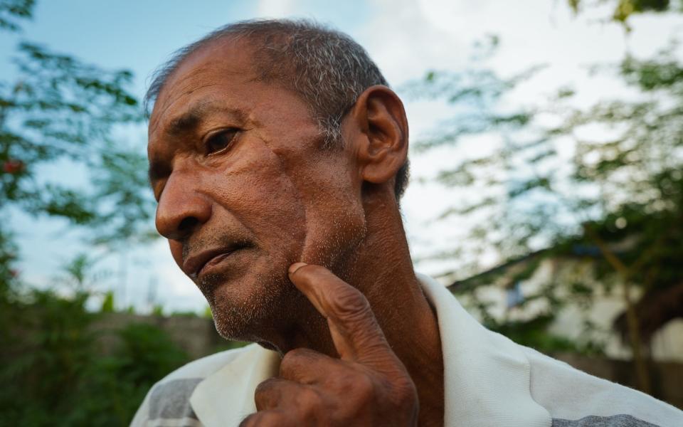 Lilarag Kumal, 61, show the facial scar sustained from a tiger attack last year