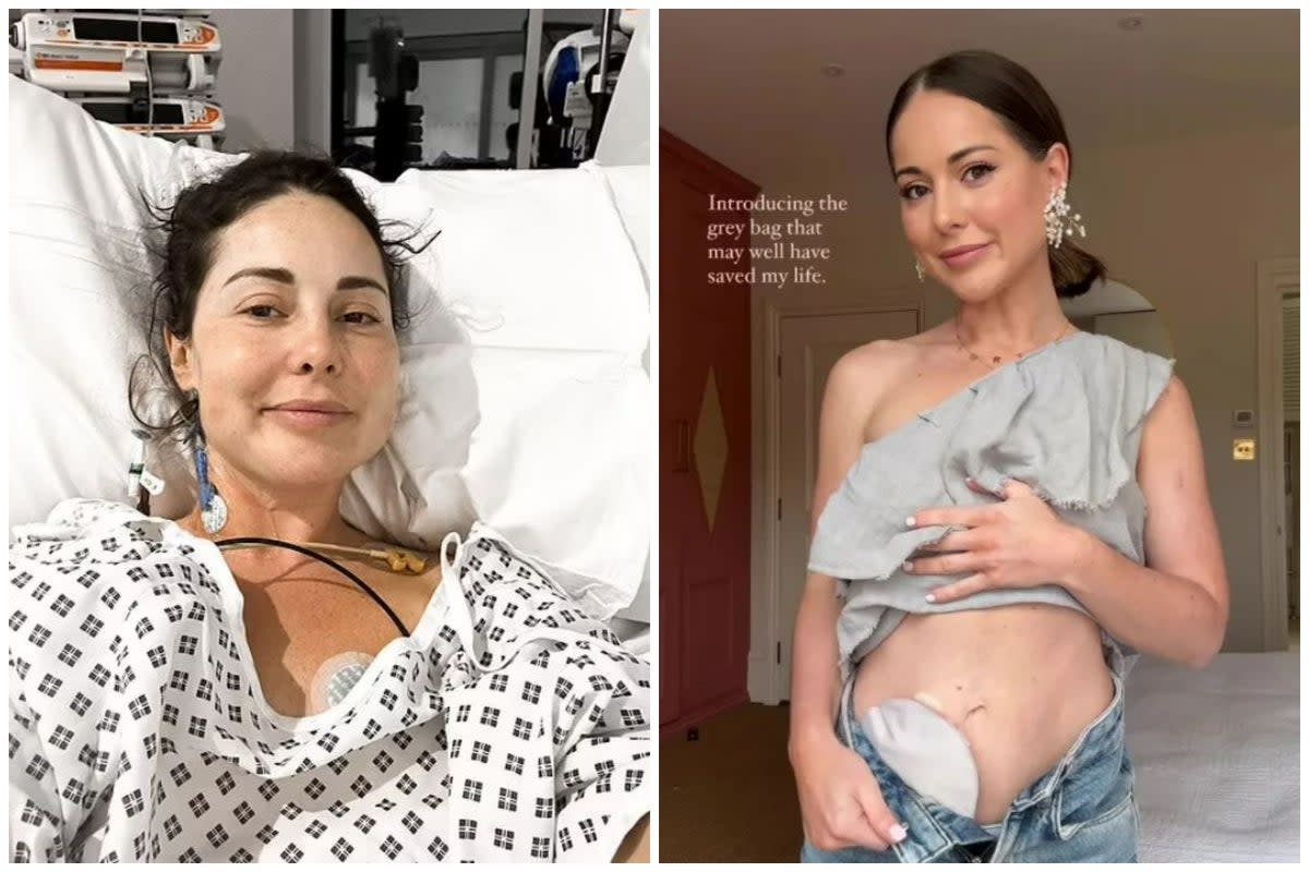 Louise Thompson has had a stoma bag fitted (Instagram @louisethompson)