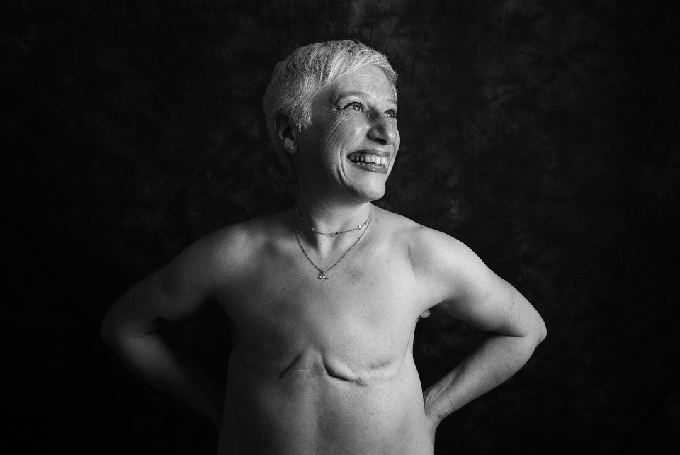 One of sixteen men and women who have bared their scars as part of a project called 'Defiance'.