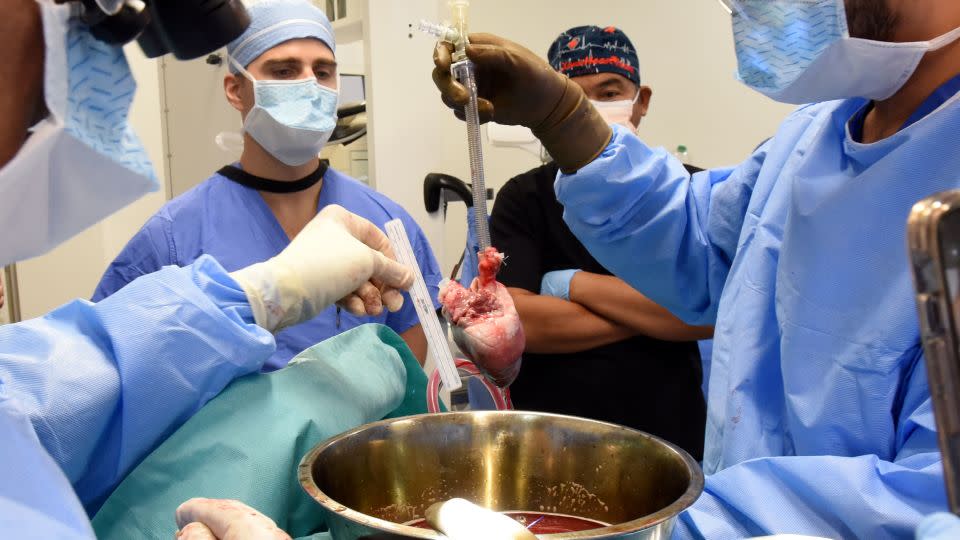 In this photo provided by the University of Maryland School of Medicine, surgeons prepare for a pig heart transplant into Lawrence Faucette at the school's hospital in Baltimore, Md., in September 2023. - Deborah Kotz/University of Maryland School of Medicine/AP