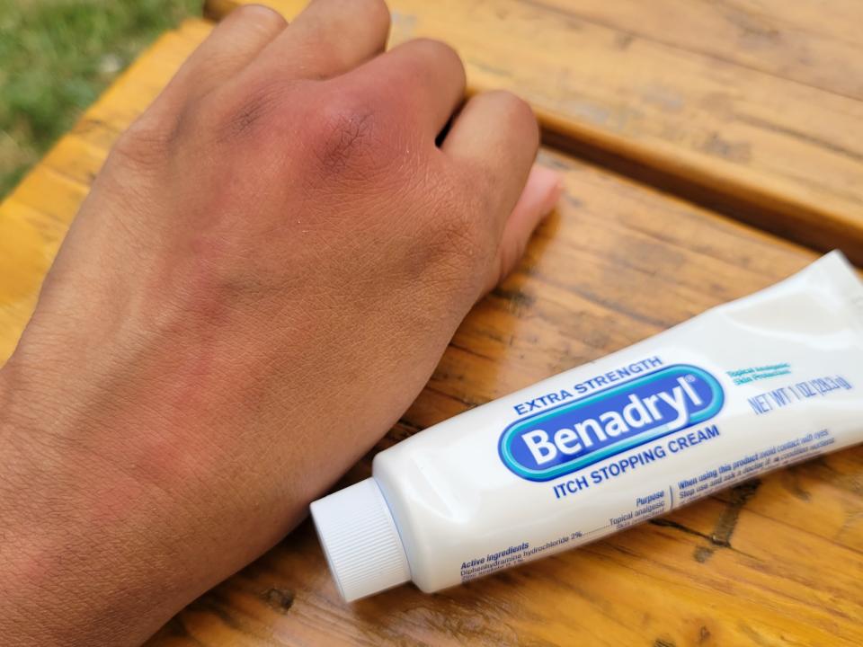 A tube of Benadryl next to a hand with mosquito bites all over.