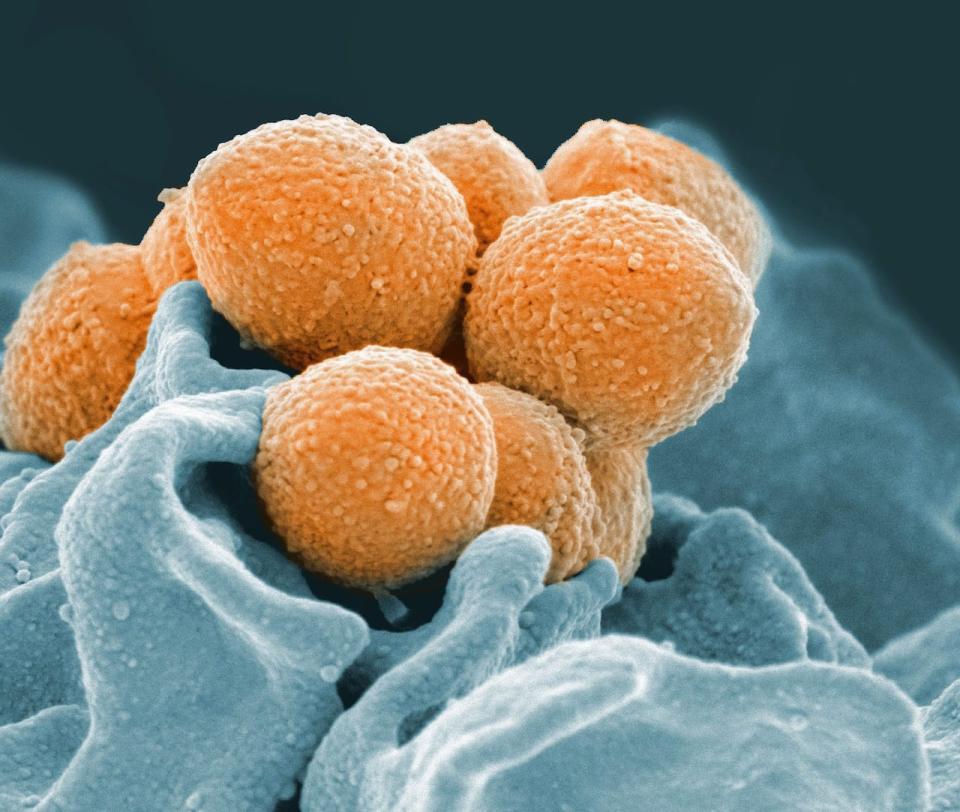 This handout image provided by the National Institute of Allergy and Infectious Diseases shows an electron microscope image of Group A Streptococcus (orange) during phagocytic interaction with a human neutrophil (blue).  The same bacteria that cause simple strep throat sometimes trigger bloodstream or even flesh-eating infections instead, and over the years, dangerous cases have increased. Now researchers have uncovered how some strains of this bug evolved to become more aggressive.  