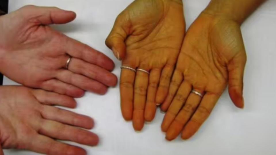「胡蘿蔔素血症」患者與正常人膚色對比。（圖／翻攝自《每日快報》）