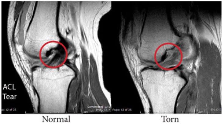 Comparative diagram of a torn and healthy ACL.