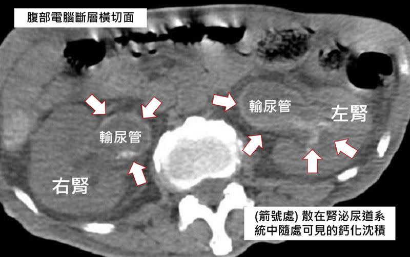 泌尿道結石很常見，結石通常是顆粒狀，竟有人的結石是滿滿覆蓋住泌尿道！（圖／翻攝自衛生福利部彰化醫院）