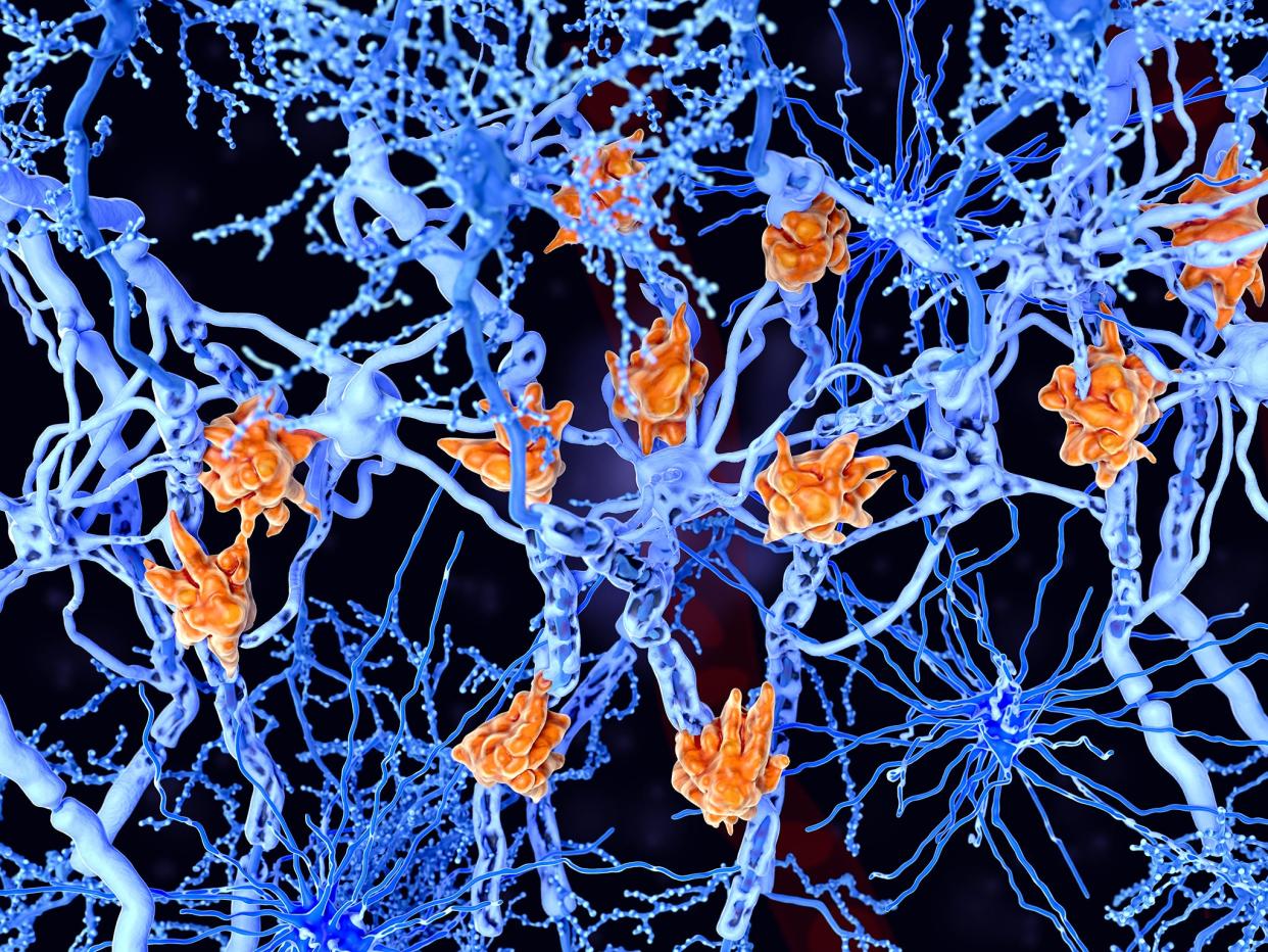 Microglia cells (orange) attack the oligodendrocytes that form the insulating myelin sheath around neuron axons, leading to the destruction of the myelin sheath and to the loss of nerve function: iStock