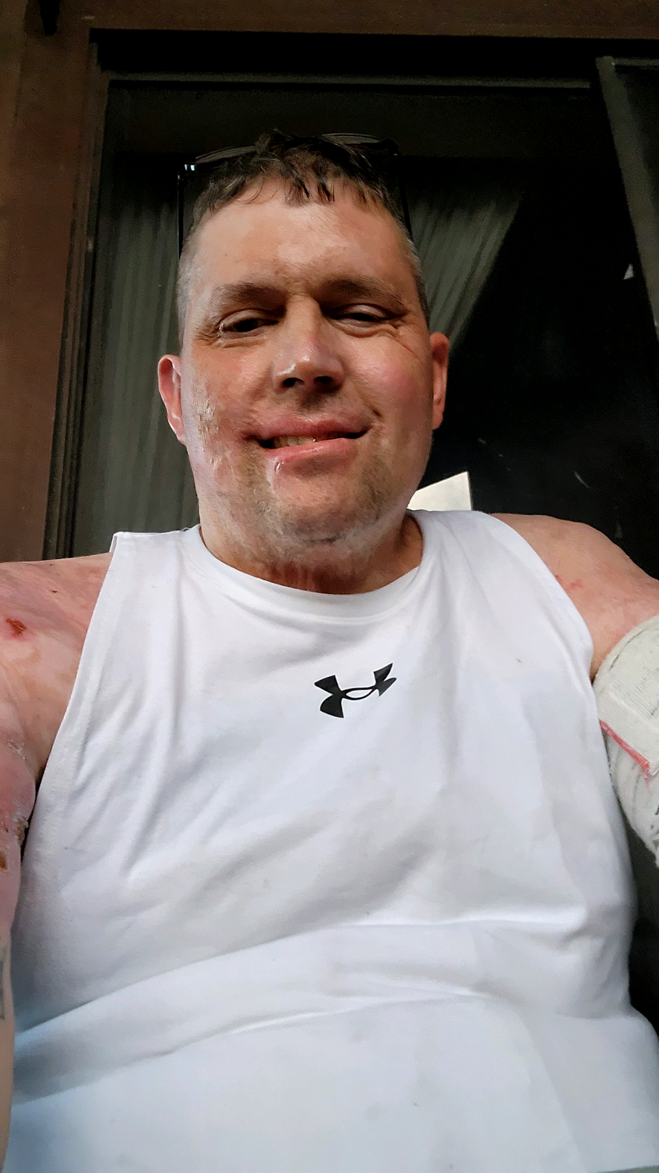 Almost a year after he was at electrocuted and badly burned over 28% of his body, Jason Shields has many of his bandages removed. He will need another year of recovery.
