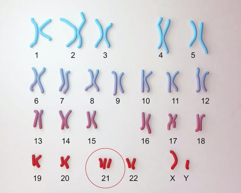 Down syndrome is also called trisomy 21 because those with the condition have three copies of chromosome 21. <a href="https://www.gettyimages.com/detail/illustration/downs-syndrome-karyotype-illustration-royalty-free-illustration/685025123" rel="nofollow noopener" target="_blank" data-ylk="slk:Kateryna Kon/Science Photo Library via Getty Images;elm:context_link;itc:0;sec:content-canvas" class="link ">Kateryna Kon/Science Photo Library via Getty Images</a>