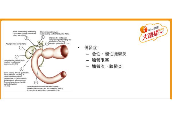 膽結石併發症。