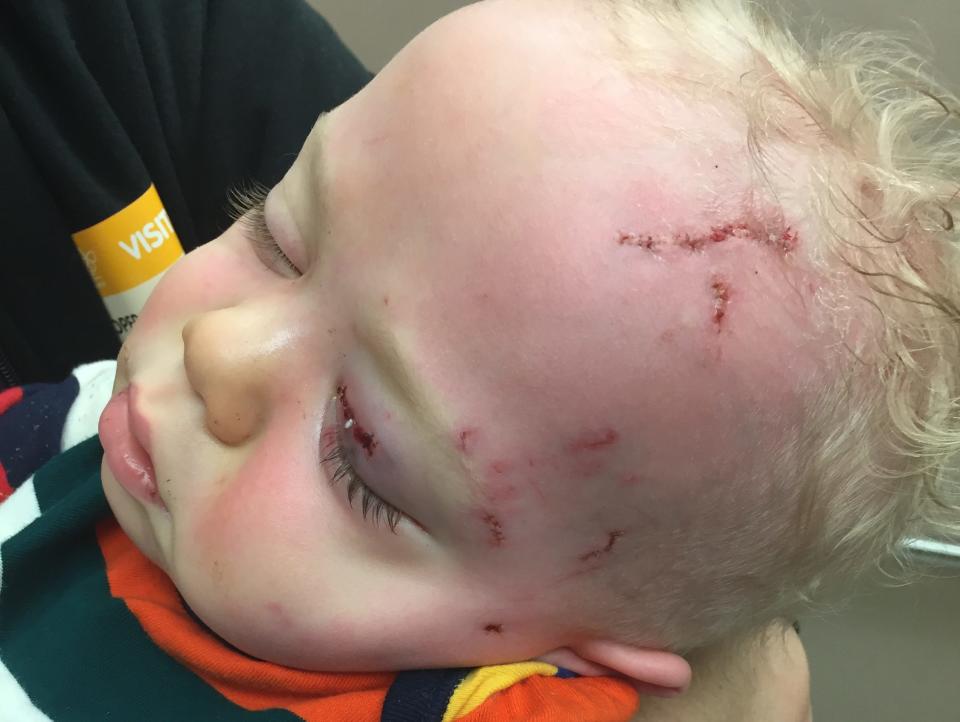 Baby with scars on his face dog attacked him