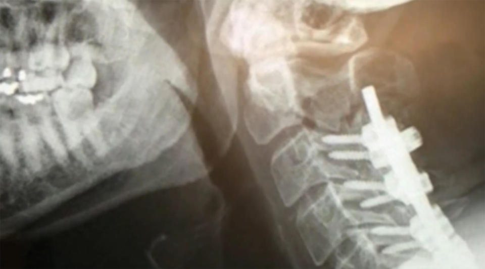An X-ray shows pins and screws used to repair Ernest Faris' broken neck.  / Credit: Ernest Faris