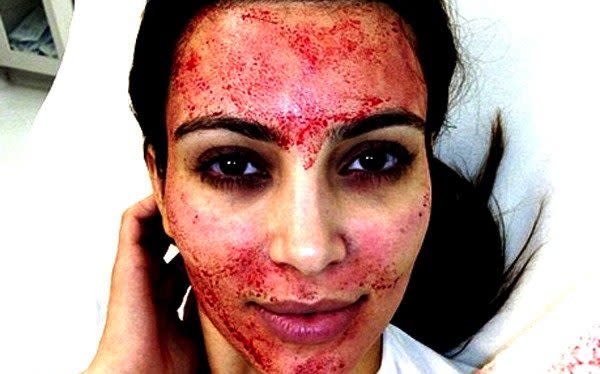 Kim Kardashian has since said that vampire facials are 'really rough and painful'. She was not treated at the VIP Spathat