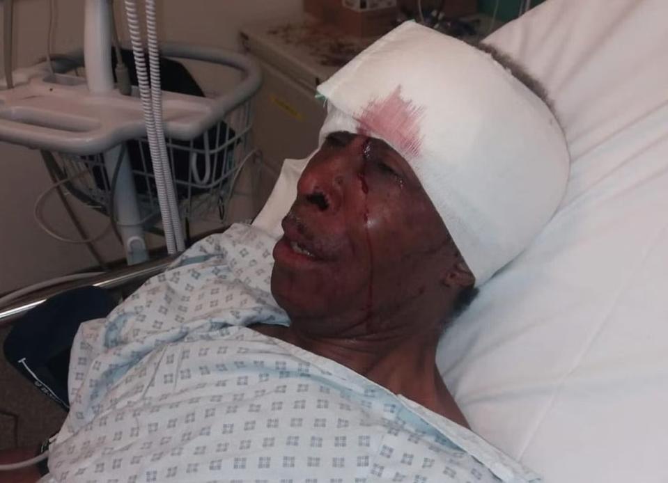 The pensioner says he suffered a broken nose, a fractured cheekbone and eye socket, and a displaced septum, which led to his hospitalisation (Supplied)