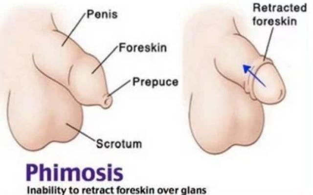 when should uncircumcised foreskin retract