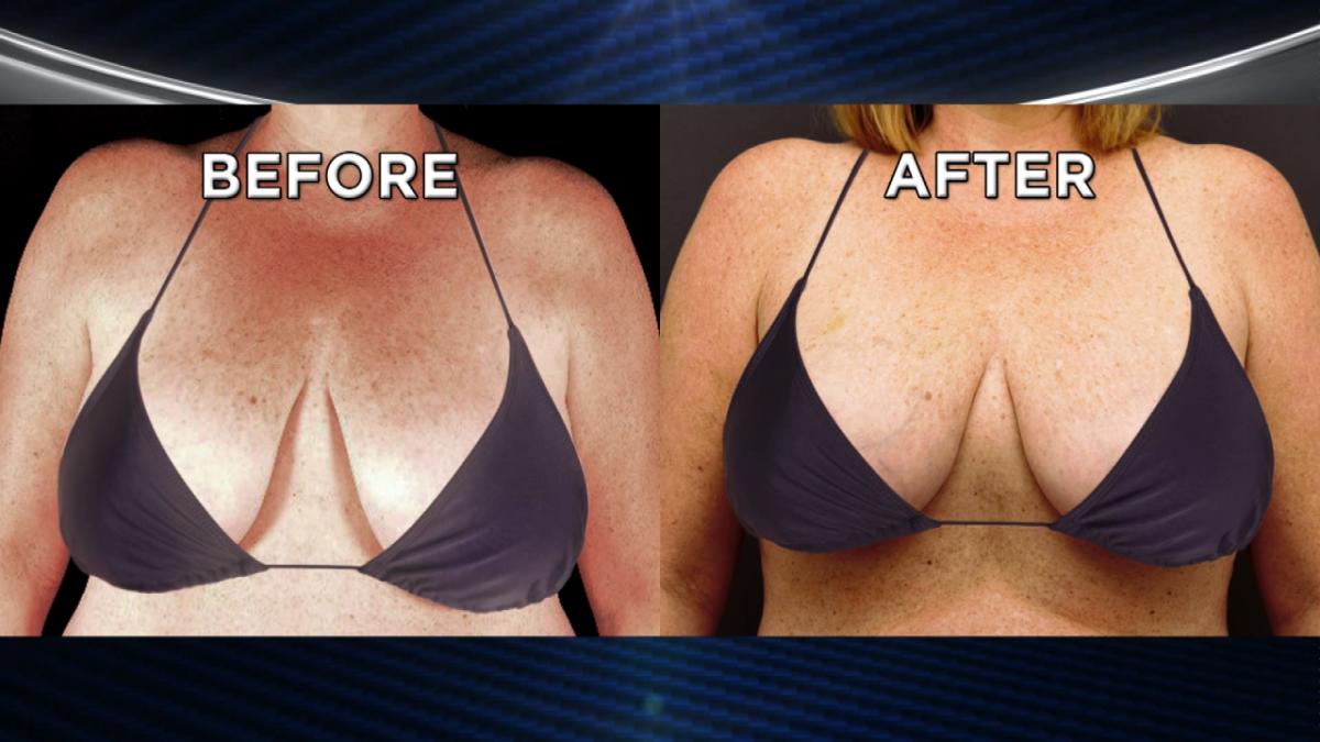 Breast Lift After Weight Loss Can Rejuvenate the Bustline - Frisco