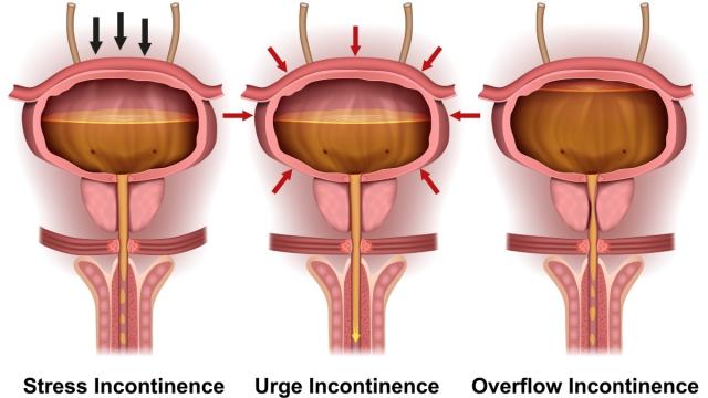 Goodbye, Bladder Leaks! Doctors Reveal the Best Natural Incontinence  Remedies