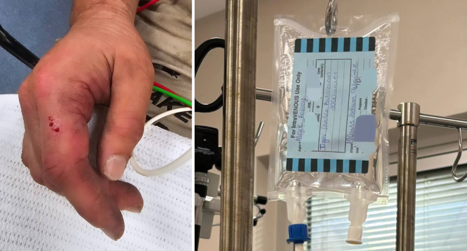 Left, the puncture wounds can be seen on Mark's right finger after he was bitten at a property in Diamond Creek, Victoria. . Right, the antivenom with Mark's name on it in the hospital. 