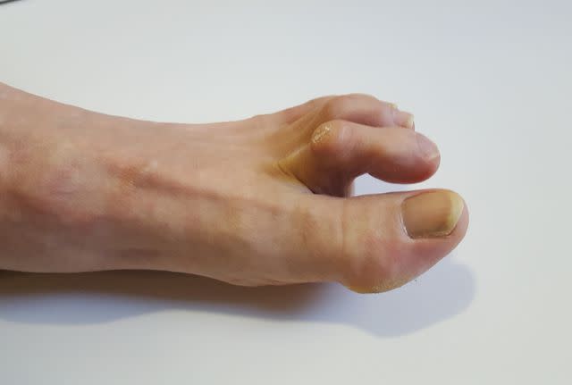 psoriatic arthritis feet