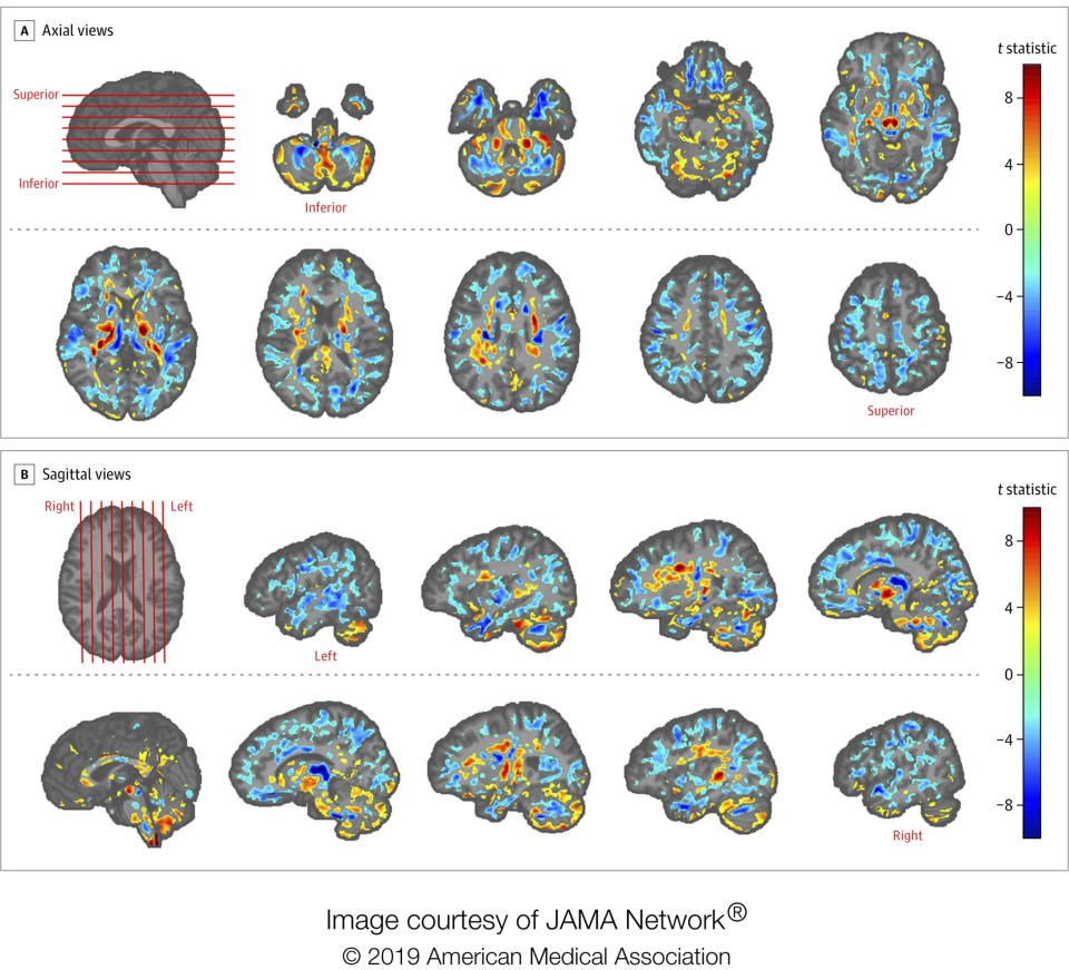 This image provided by the American Medical Association in July 2019 shows the amount of differences between brain scans of patients, U.S. diplomats who developed concussion-like symptoms after working in Cuba, and a control group. Between late 2016 and May 2018, several U.S. and Canadian diplomats in Havana complained of health problems from an unknown cause. One U.S. government count put the number of American personnel affected at 26. (American Medical Association via AP)