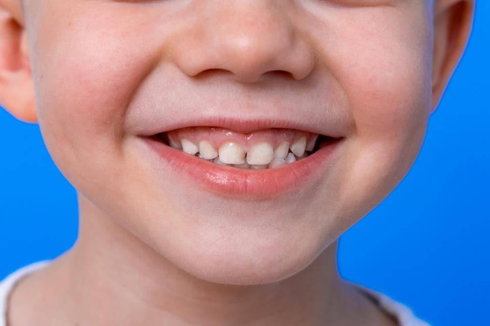 close up of child's teeth as they smile