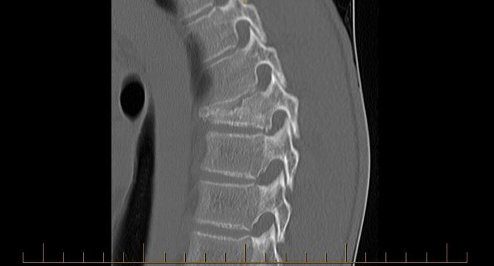 An X-ray of the curved spine suffered by cyclist Harry Kooros after he hit a pothole in Bowral and fractured three vertebrae. Source: Supplied/ Harry Kooros