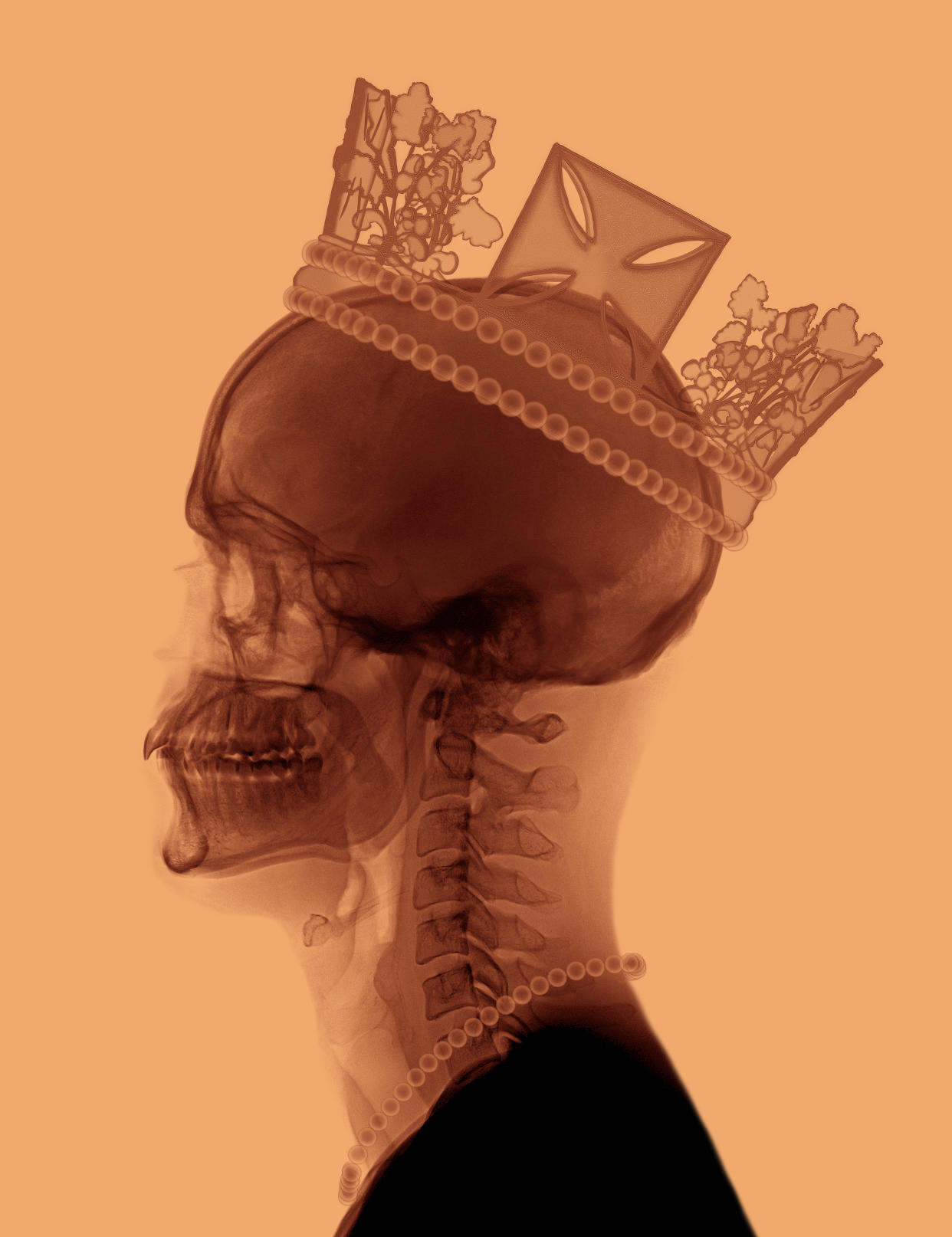 Ernesto Romano's X-Ray Queen 