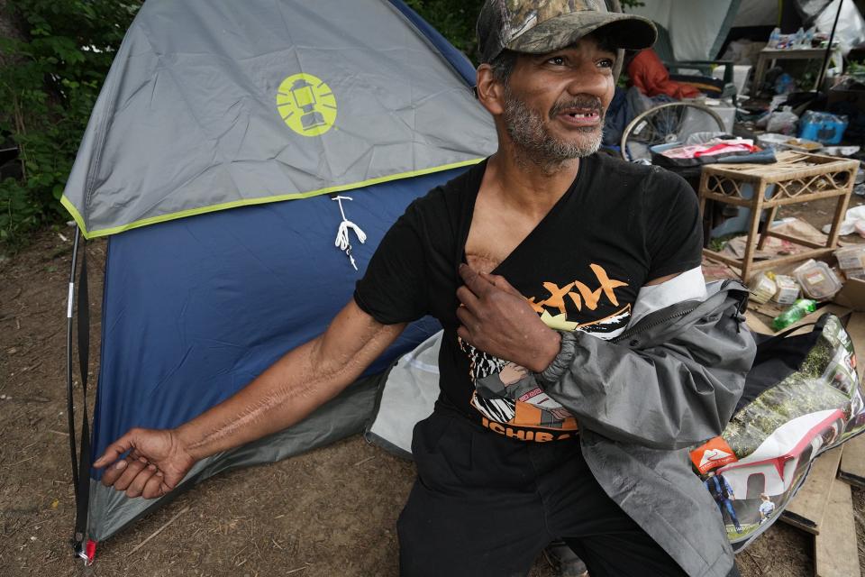 Tony Holbrook, 48, who lives at a homeless camp near the now-closed Heer Park on Columbus' Far South Side, displays scars from what he said was when he had a flesh-eating virus.