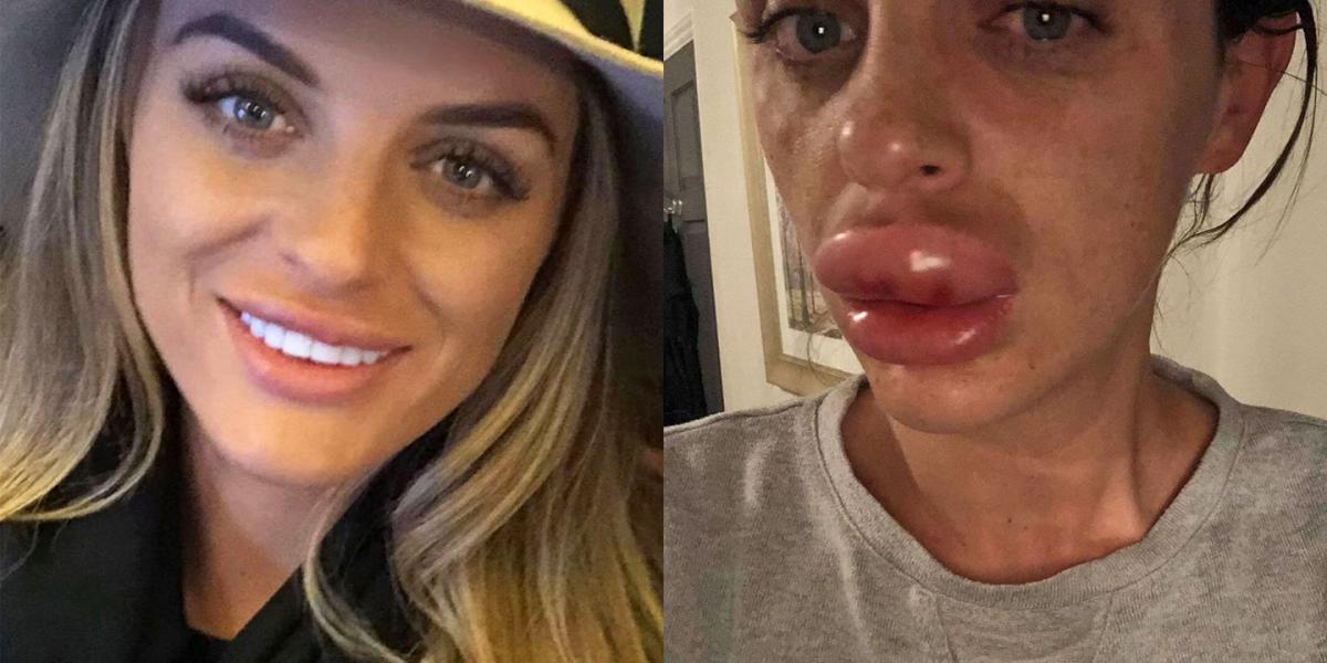 This Womans Botched Fillers Made Her Lips Swell 5x Their Normal Size 9755