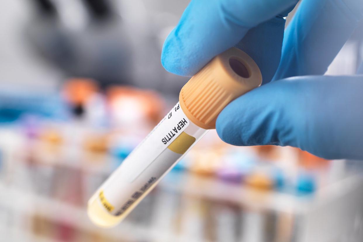 Medical technician preparing a human sample for hepatitis testing