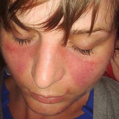 lupus butterfly rash identification