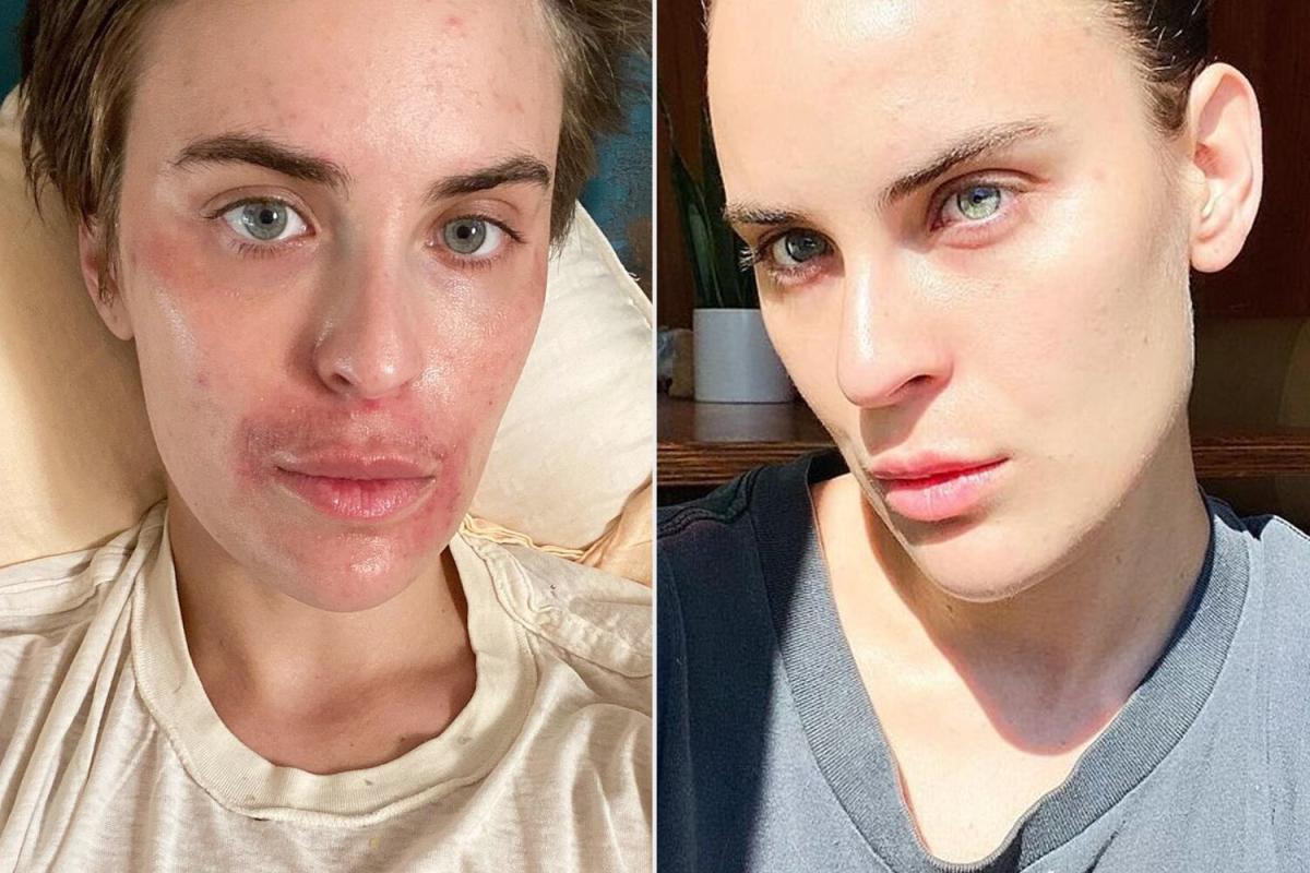 Candid Florida Nude Beach - Tallulah Willis Gets Candid About Her Skin Strugglesâ€”and Says She's 'Truly  Proud' of Her Progress