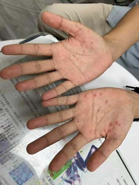 男病患的手掌冒大大小小的紅斑。（圖／翻攝自理雞先生 ― 泌尿科施冠偉醫師臉書）