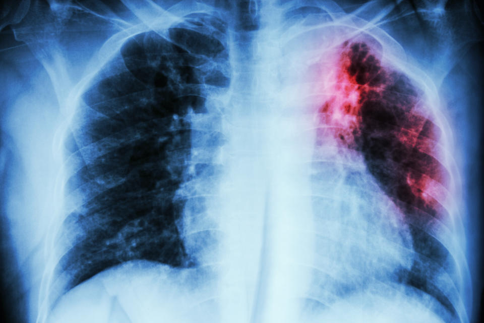 Radiografía de tórax que muestra una infiltración intersticial (el tejido conectivo que forma la estructura de soporte de los alvéolos o sacos de aire de los pulmones) en el pulmón superior izquierdo debido a la infección por Mycobacterium Tuberculosis. (Foto: Getty)