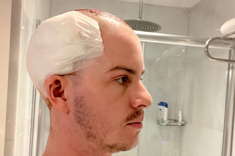 Following the first hair transplant in Turkey
