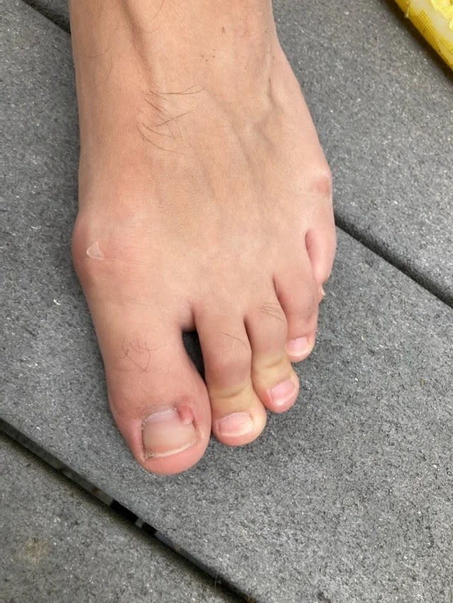 A person's foot showing the big toe with a small growth near the quick that looks like a miniature toe