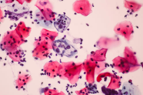 <span class="caption">Close-up of abnormal cells from Pap smear.</span> <span class="attribution"><a class="link " href="https://www.shutterstock.com/download/confirm/480485131?src=pXWcLFWIh0Xead-Ch3t4oQ-1-6&size=medium_jpg" rel="nofollow noopener" target="_blank" data-ylk="slk:Komsan Loonprom/Shutterstock;elm:context_link;itc:0;sec:content-canvas">Komsan Loonprom/Shutterstock</a></span>