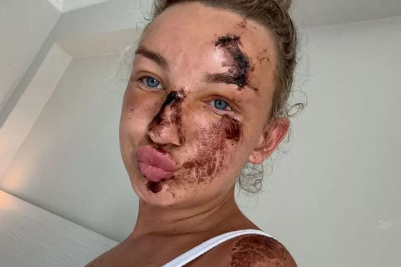 Holly Thomas showing her face and shoulder injuries